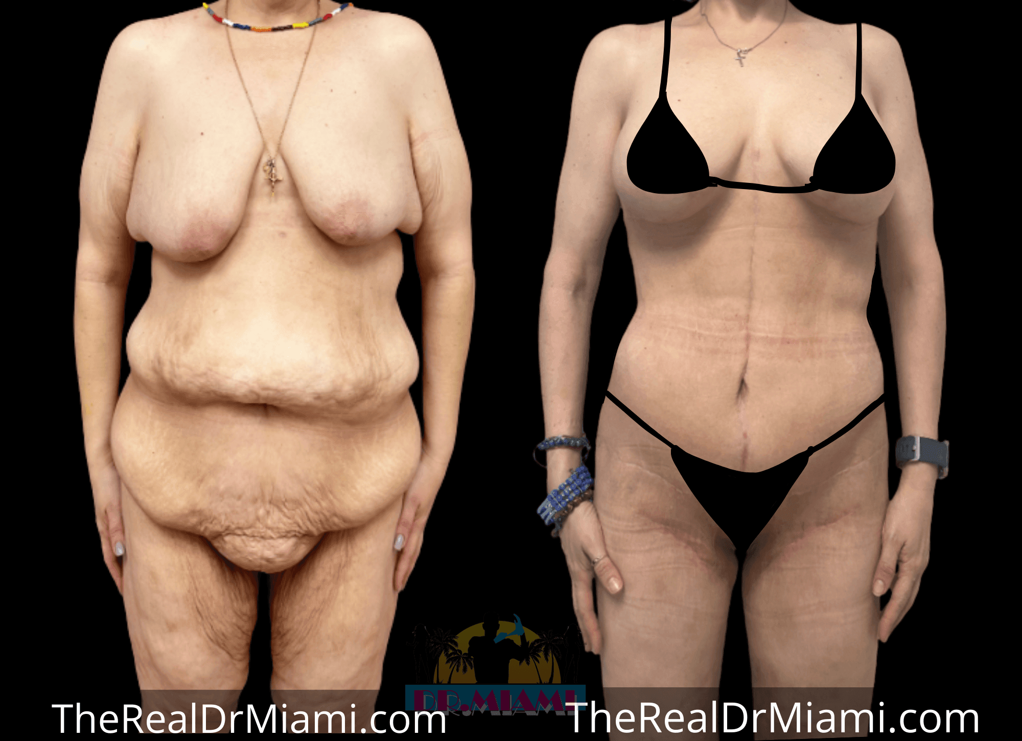 Before-and-after views for Massive Weight Loss, Case 12.