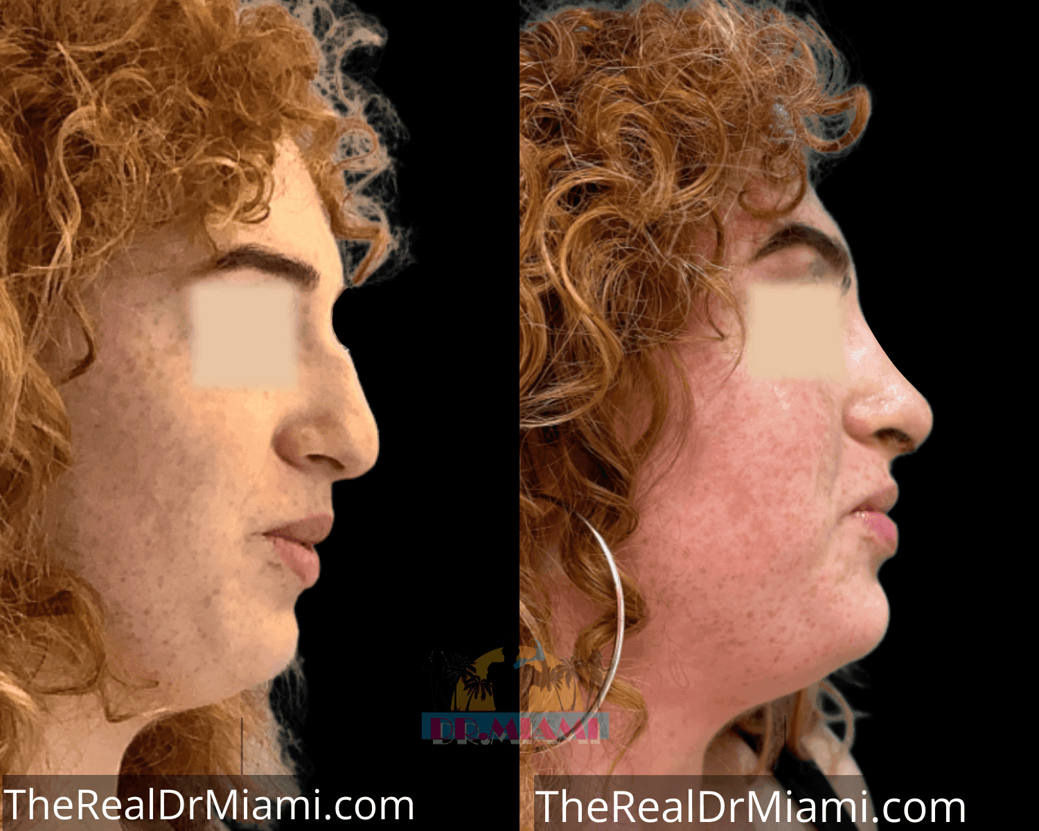 Before-and-after views for Rhinoplasty, Case 47.