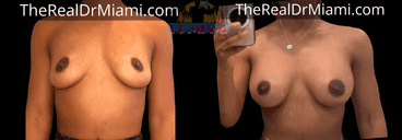 Before-and-after views for Breast Augmentation, Case 80.