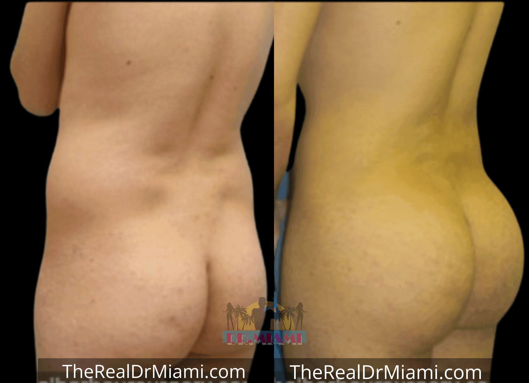 Before-and-after views for Brazilian Butt Lift, Case 76.