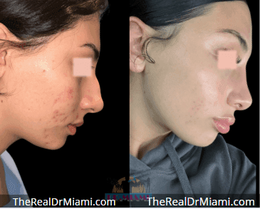 Before-and-after views for Rhinoplasty, Case 115.