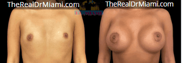 Before-and-after views for Breast Augmentation, Case 33.