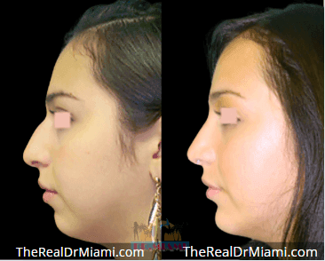 Before-and-after views for Rhinoplasty, Case 81.