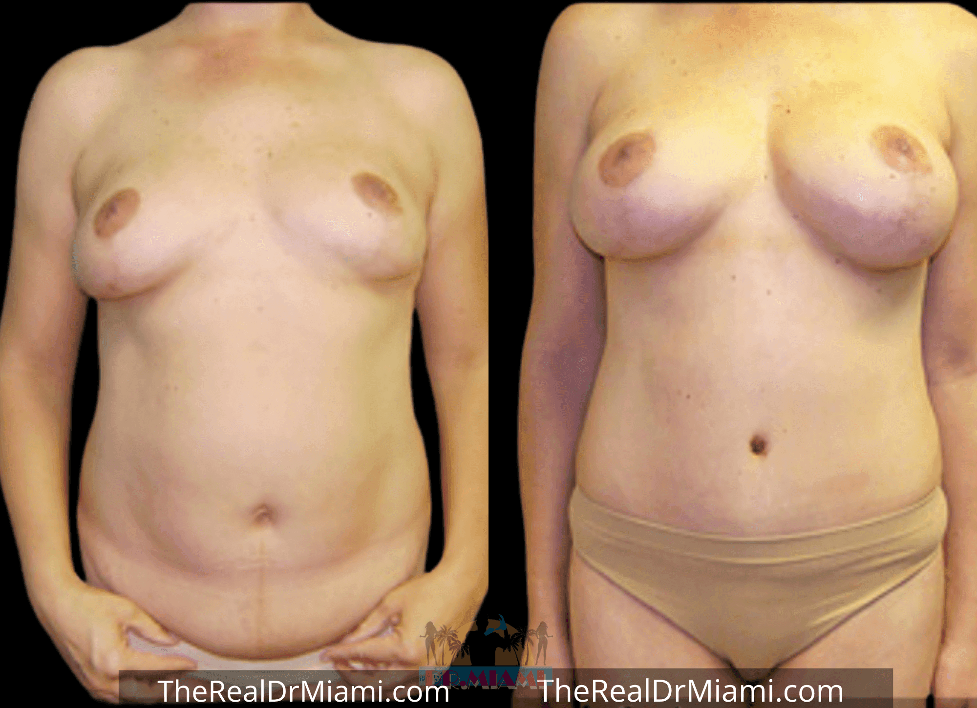 Before-and-after views for Tummy Tuck, Case 81.