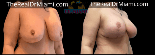 Before-and-after views for Breast Lift, Case 76.