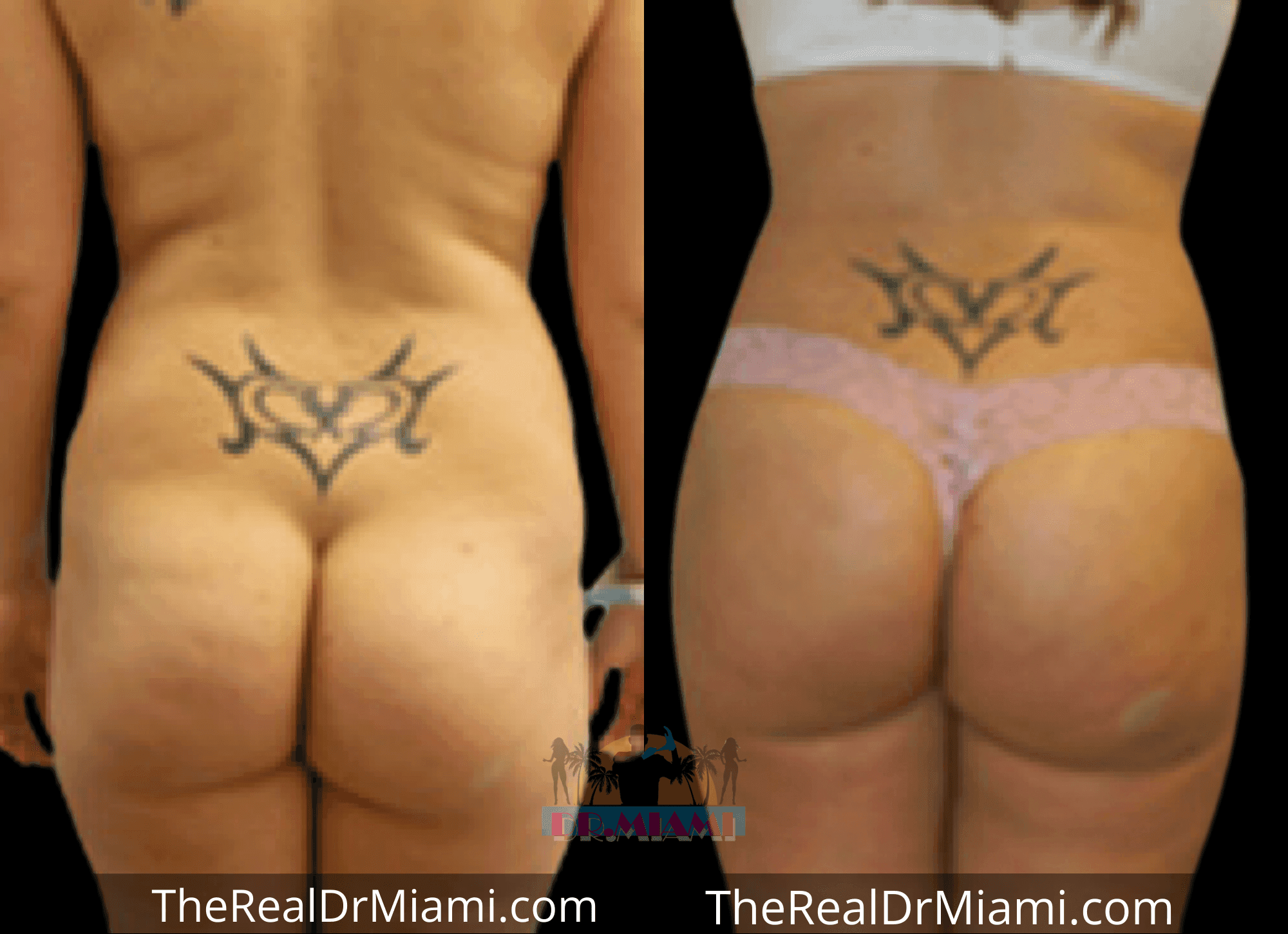 Before-and-after views for Brazilian Butt Lift, Case 85.