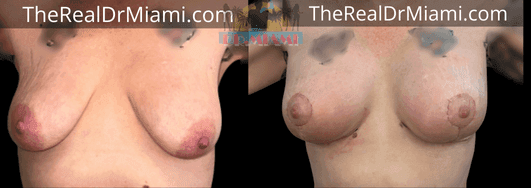 Before-and-after views for Breast Lift, Case 98.