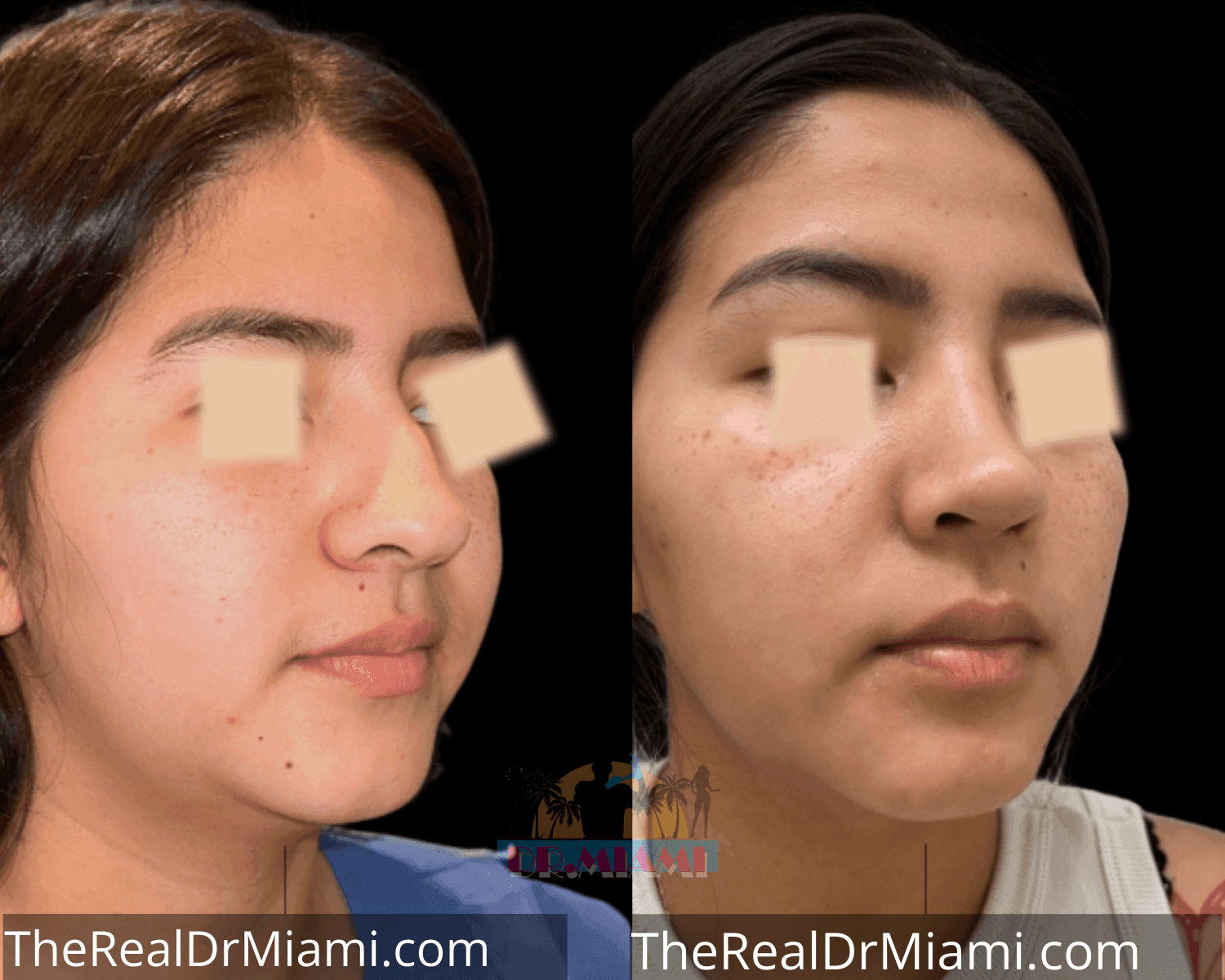 Before-and-after views for Rhinoplasty, Case 41.