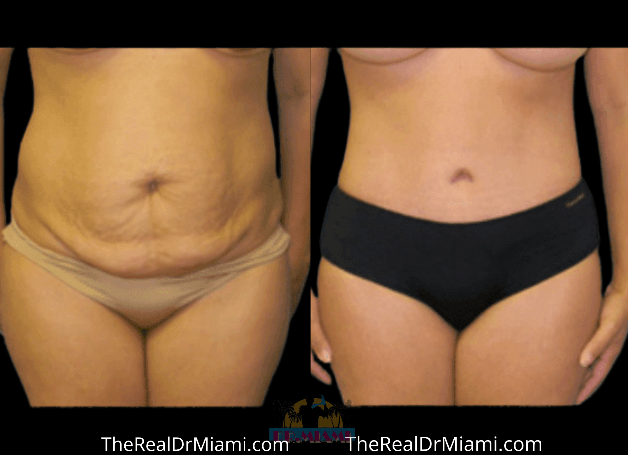 Before-and-after views for Tummy Tuck, Case 96.