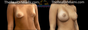 Before-and-after views for Breast Augmentation, Case 84.