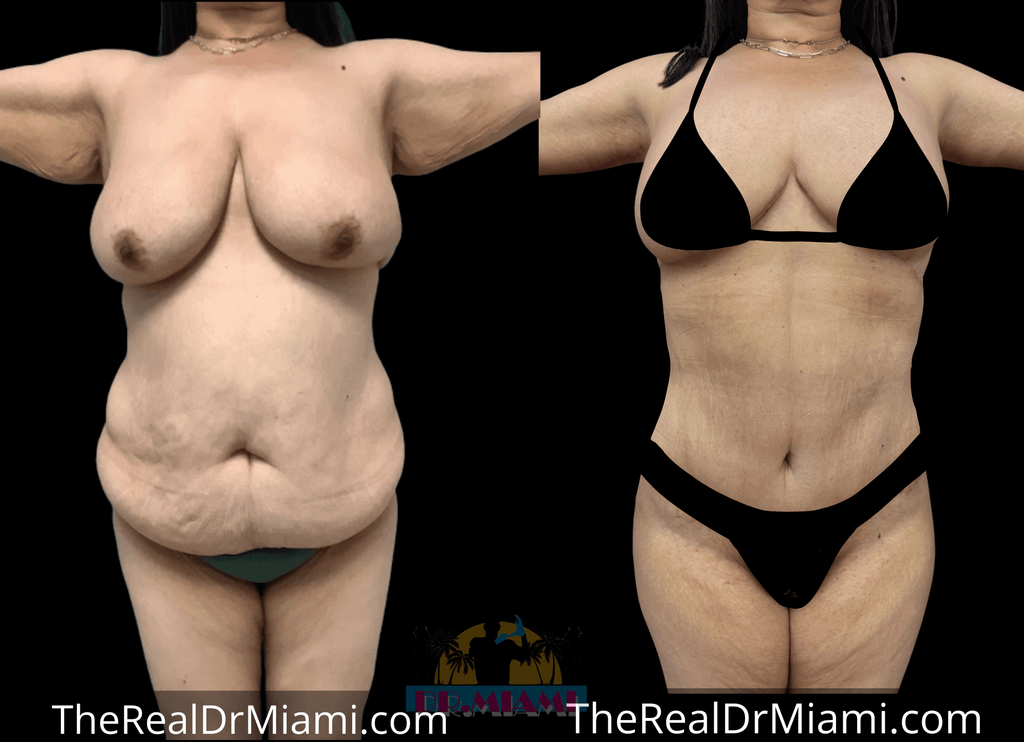 Before-and-after views for Massive Weight Loss, Case 3.