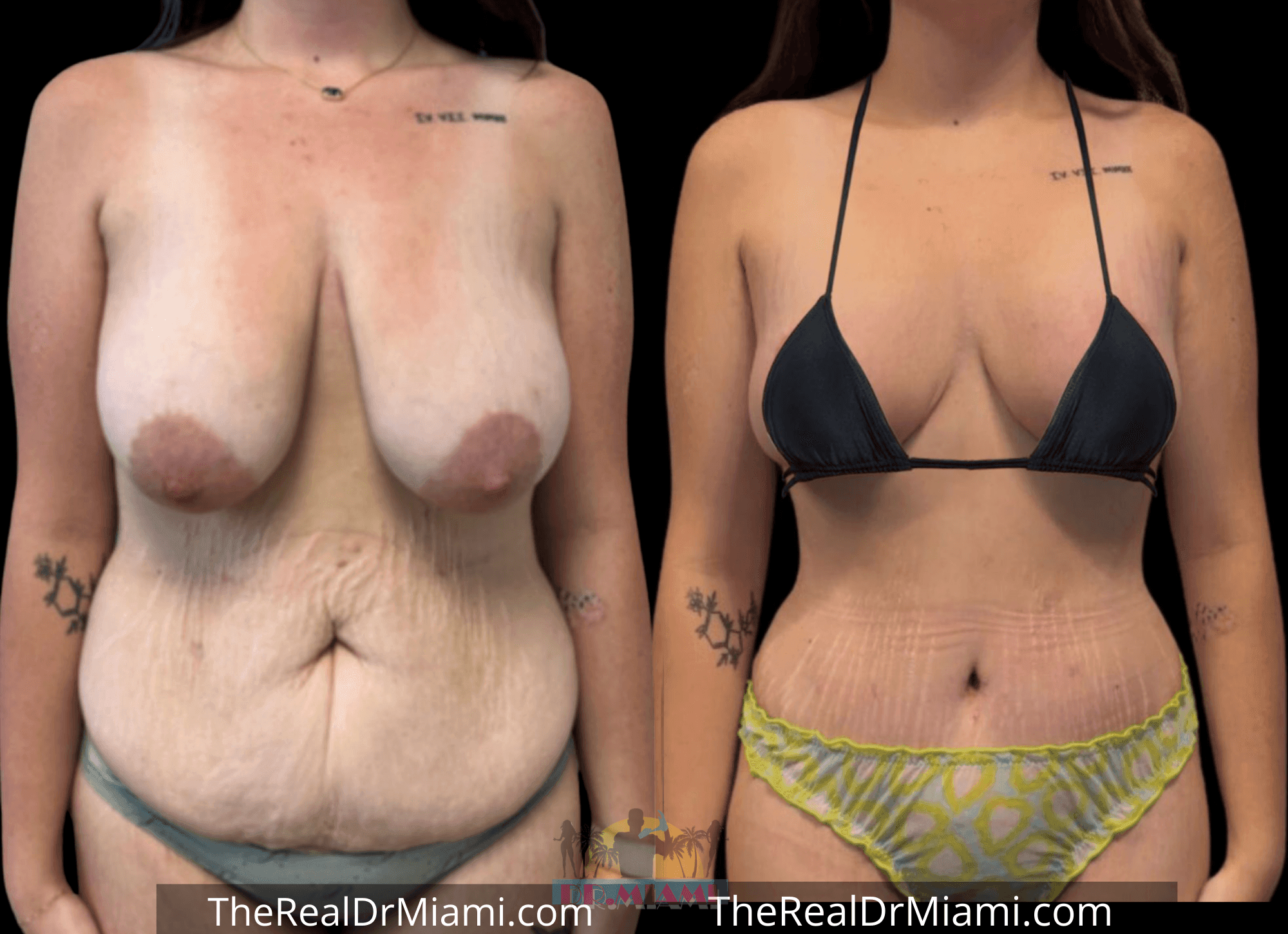 Before-and-after views for Mommy Makeover, Case 6.