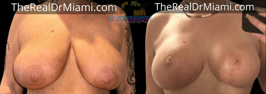 Before-and-after views for Breast Lift, Case 11.