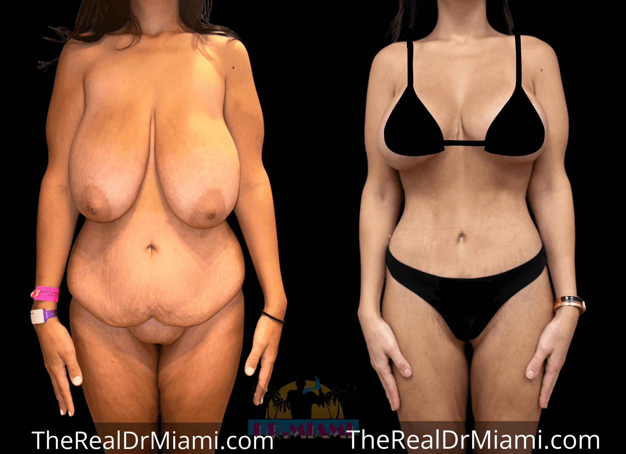 Before-and-after views for Massive Weight Loss, Case 1.