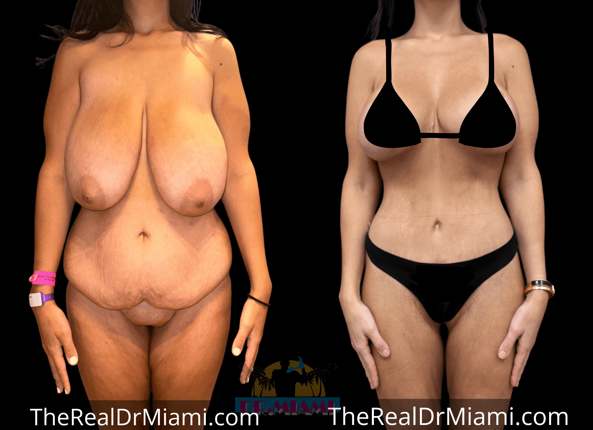 Before-and-after views for Massive Weight Loss, Case 1.