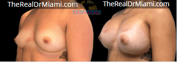 Before-and-after views for Breast Augmentation, Case 20.
