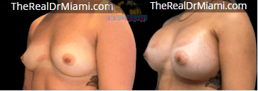 Before-and-after views for Breast Augmentation, Case 20.