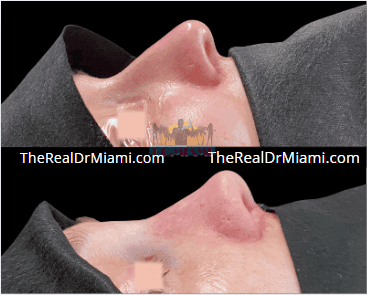 Before-and-after views for Rhinoplasty, Case 108.