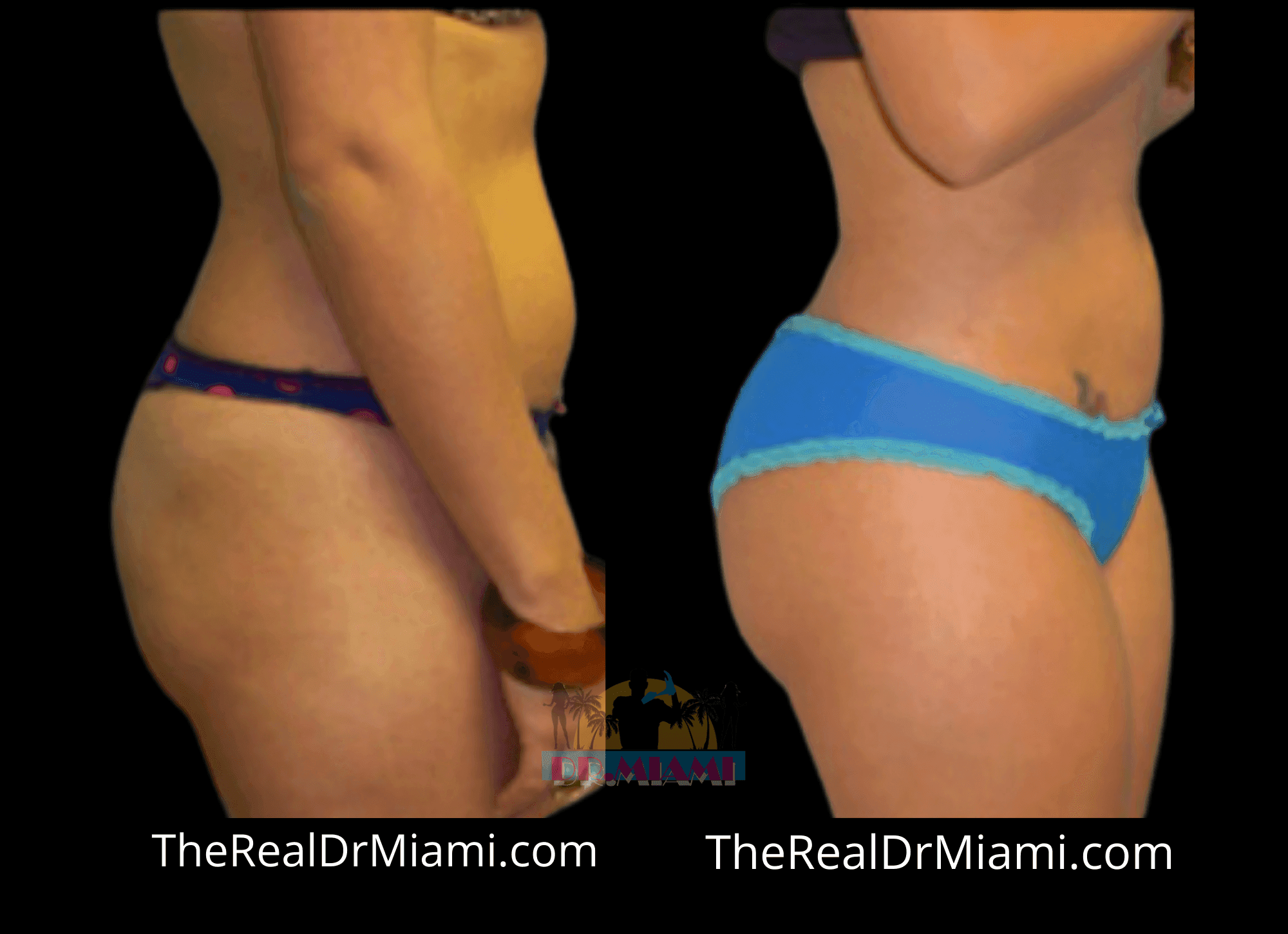 Before-and-after views for Brazilian Butt Lift, Case 45.