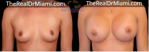Before-and-after views for Breast Augmentation, Case 101.