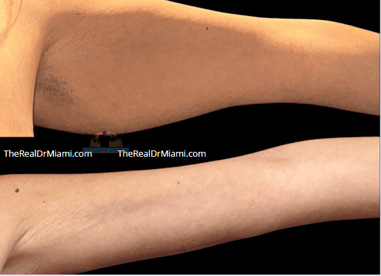 Before-and-after views for Upper Arm Lift, Case 14.