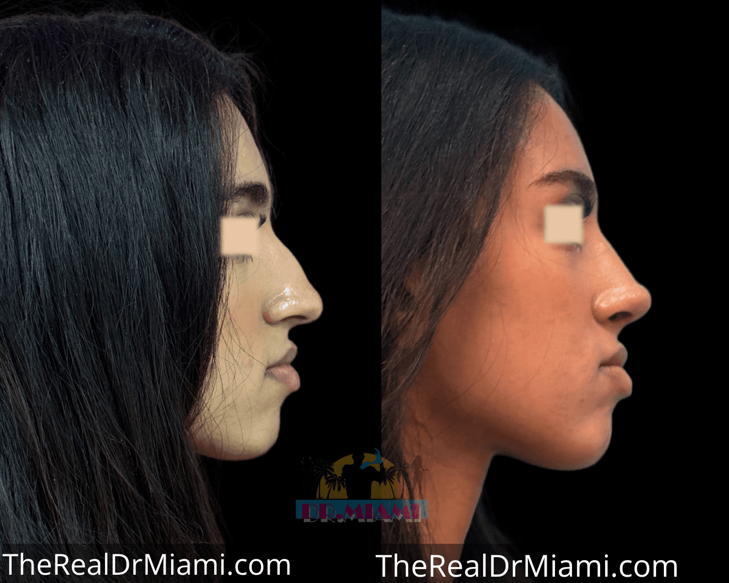 Before-and-after views for Rhinoplasty, Case 20.