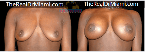 Before-and-after views for Breast Augmentation, Case 94.