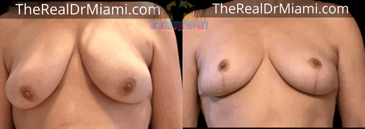 Before-and-after views for Breast Lift, Case 55.