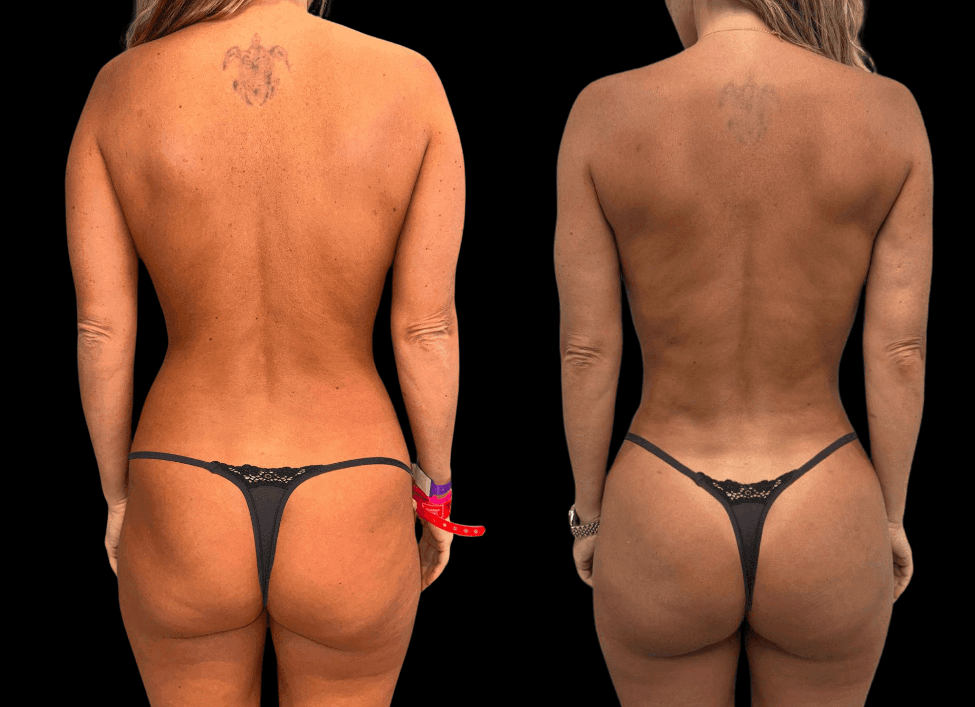 Before-and-after views for Brazilian Butt Lift, Case 34.