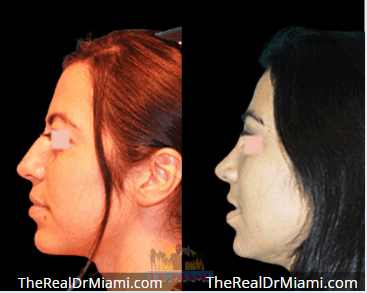 Before-and-after views for Rhinoplasty, Case 94.