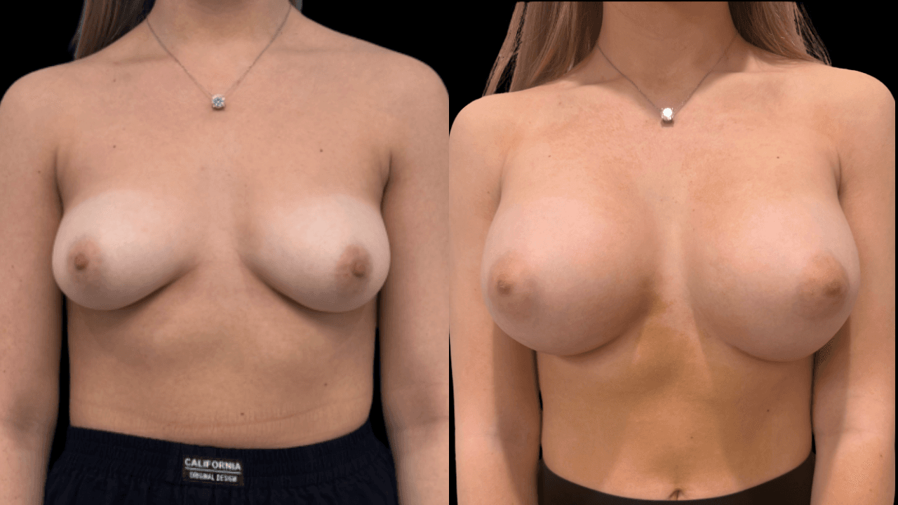 Before-and-after views for Breast Augmentation / Lift, Case 9 from The Next Dr. Miami collection.
