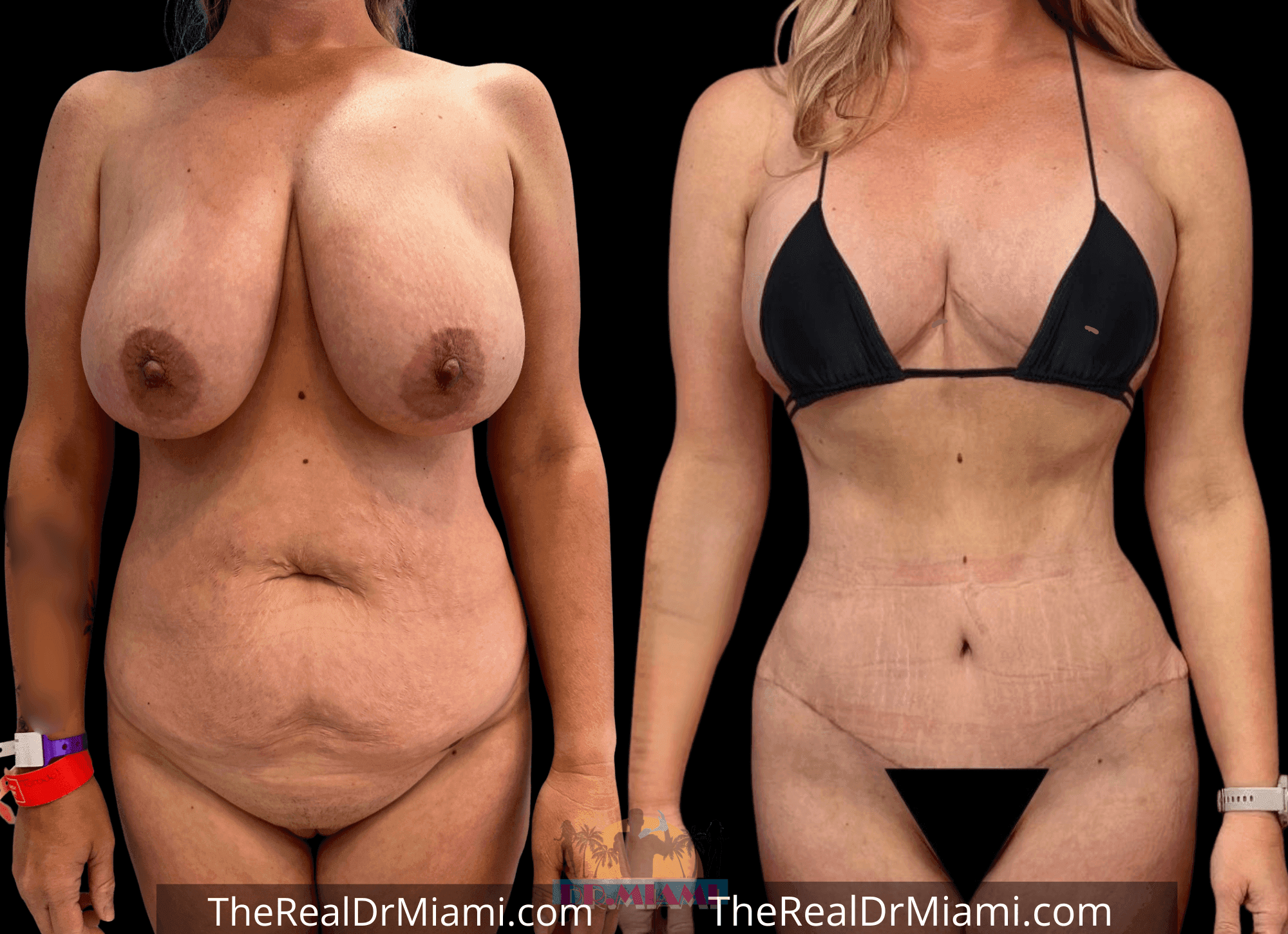 Before-and-after views for Mommy Makeover, Case 121.