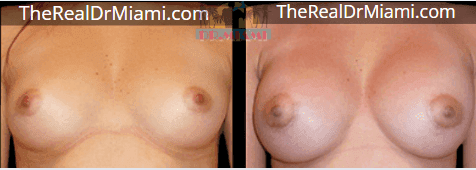 Before-and-after views for Breast Augmentation, Case 112.