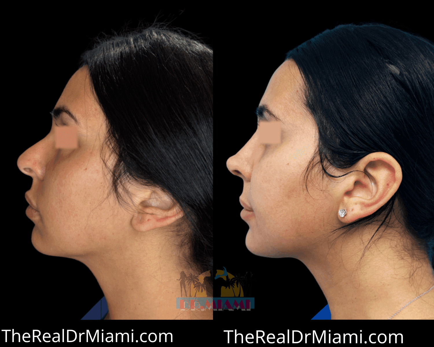 Before-and-after views for Rhinoplasty, Case 132 — Additional result.