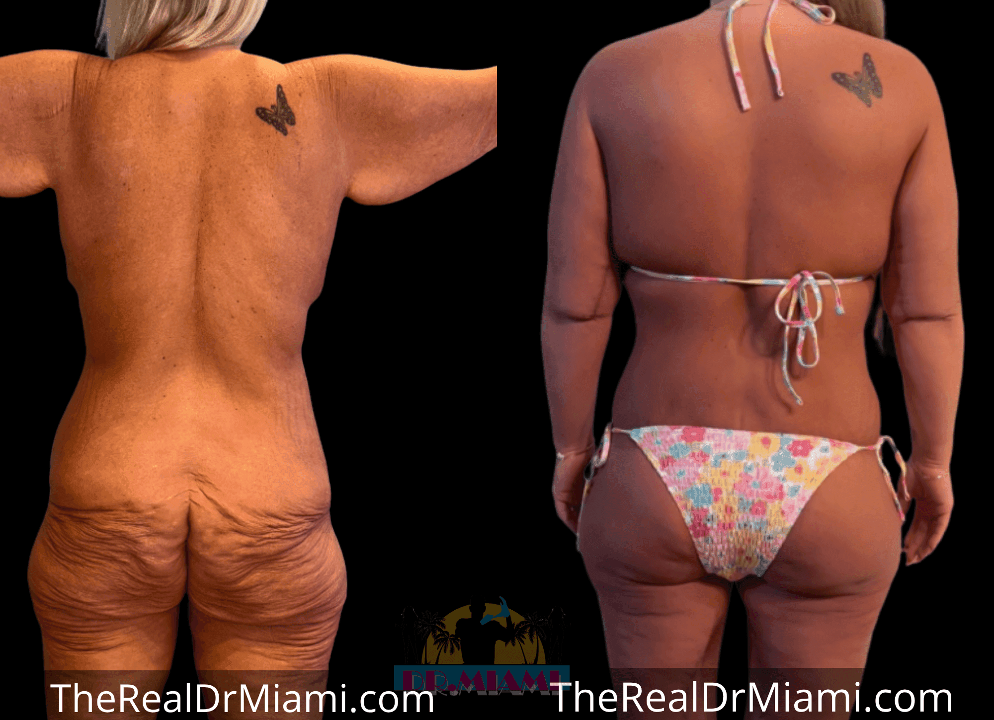 Before-and-after views for Massive Weight Loss, Case 17.