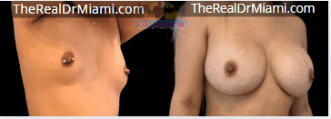 Before-and-after views for Breast Augmentation, Case 50.