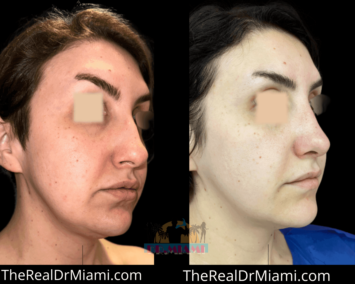 Before-and-after views for Rhinoplasty, Case 37.