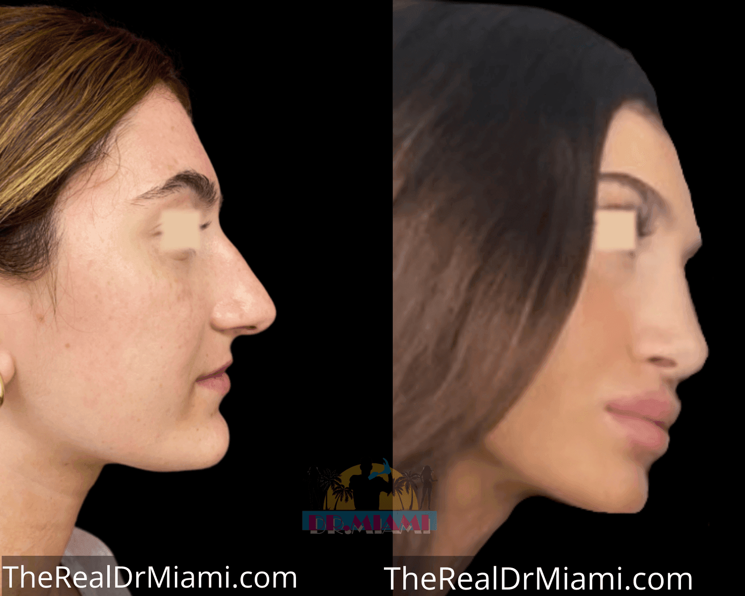 Before-and-after views for Rhinoplasty, Case 48.