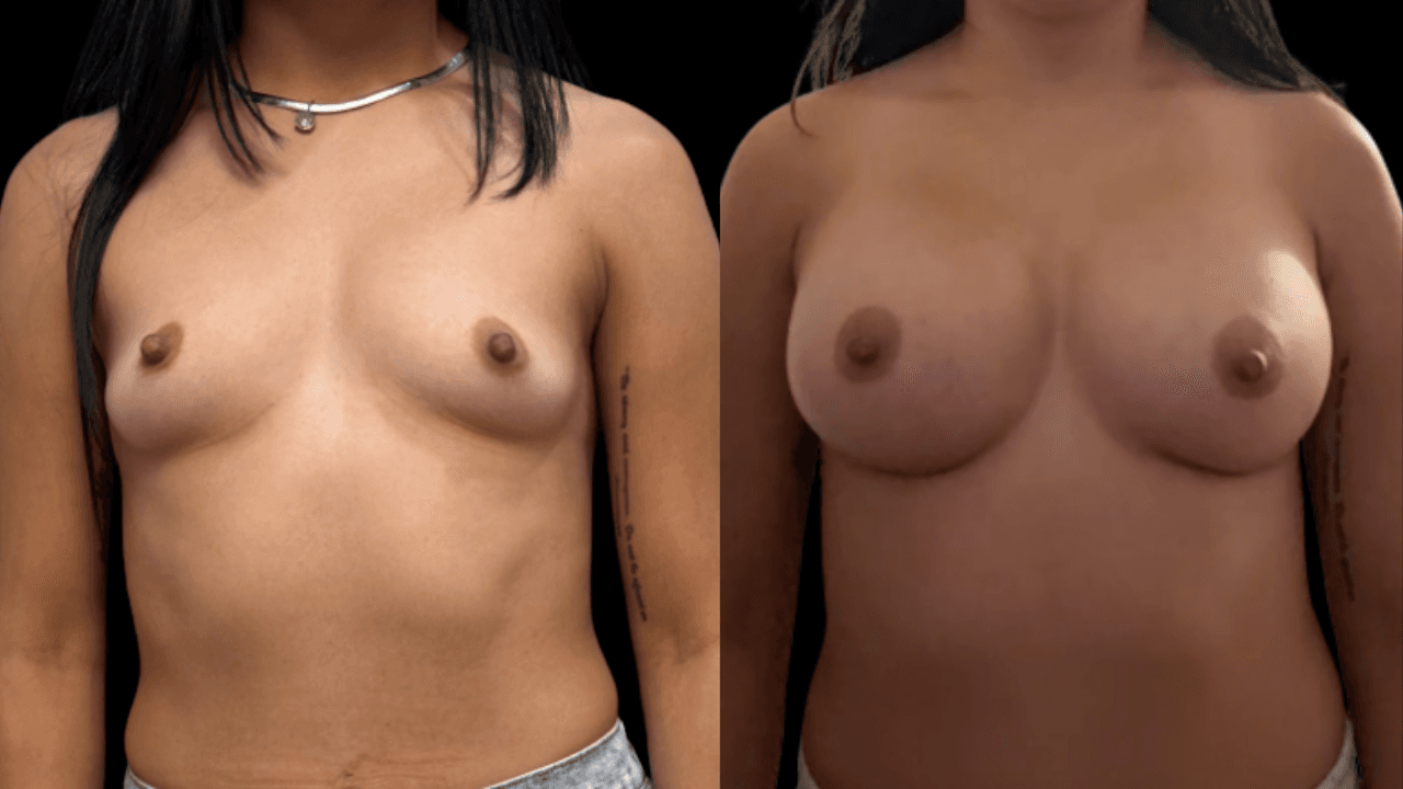 Before-and-after views for Breast Augmentation / Lift, Case 2 from The Next Dr. Miami collection.