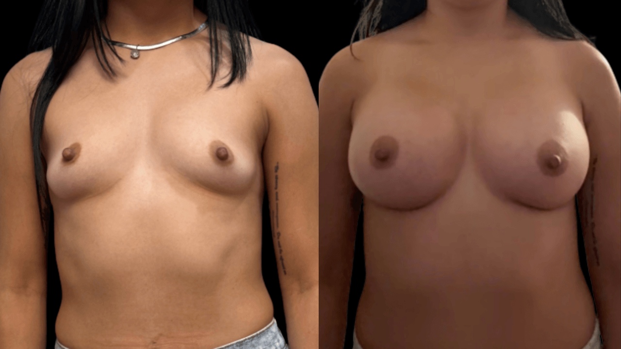 Before-and-after views for Breast Augmentation / Lift, Case 2 from The Next Dr. Miami collection.