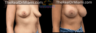 Before-and-after views for Breast Augmentation, Case 82.