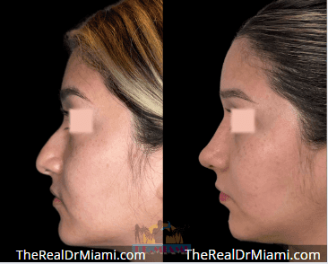 Before-and-after views for Rhinoplasty, Case 114.