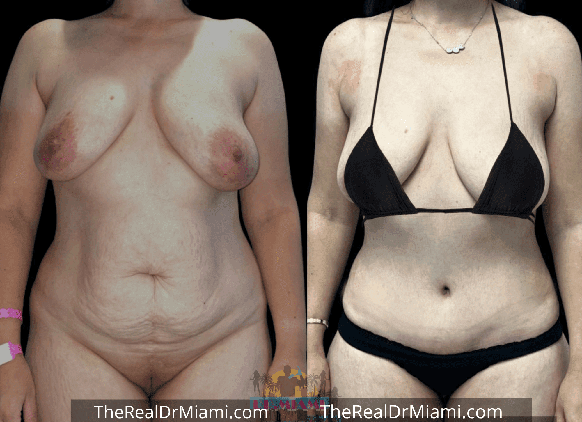 Before-and-after views for Tummy Tuck, Case 20.