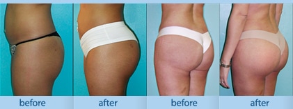 Buttock Augmentation in Miami, Brazilian butt lift miami